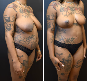 Mommy makeover before and after photo, front view