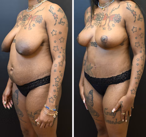 Mommy makeover before and after photo, front view