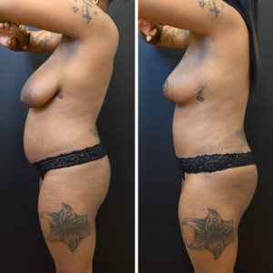 Mommy makeover before and after photo, side view