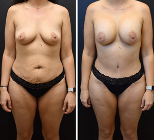 Mommy makeover before and after photo, front view