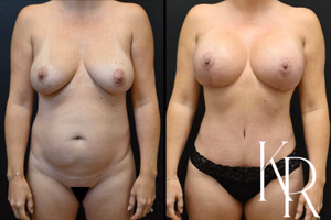 Mommy makeover before and after photo, front view