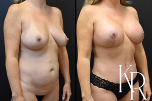 Mommy makeover before and after photo, oblique view