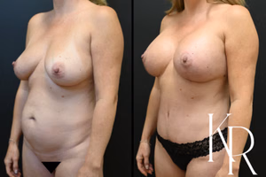 Mommy makeover before and after photo, oblique view