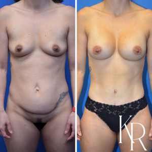 Mommy makeover before and after photo, front view