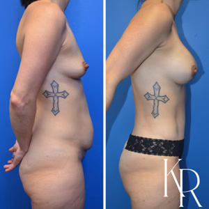 Mommy makeover before and after photo, side view