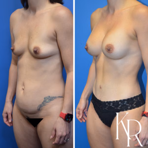 Mommy makeover before and after photo, front view
