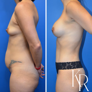 Mommy makeover before and after photo, side view