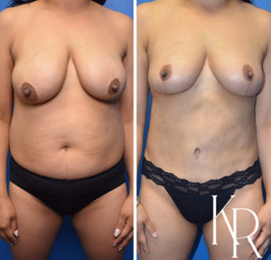 Mommy makeover before and after photo, front view