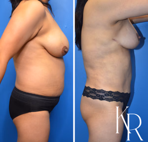 Mommy makeover before and after photo, side view
