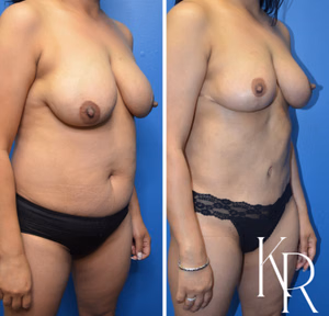 Mommy makeover before and after photo, front view