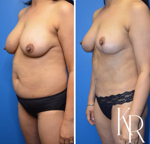 Mommy makeover before and after photo, front view