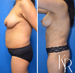 Mommy makeover before and after photo, side view