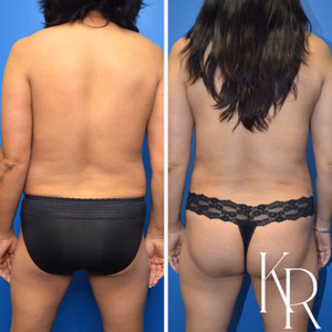 Mommy makeover before and after photo, side view
