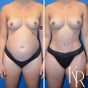 Mommy makeover before and after photo, front view