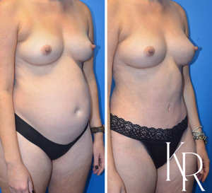 Mommy makeover before and after photo, side view