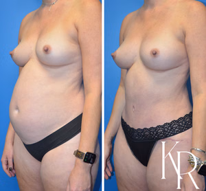 Mommy makeover before and after photo, front view