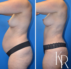 Mommy makeover before and after photo, side view
