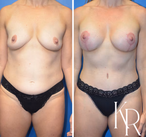 Mommy makeover before and after photo, rear view