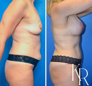 Mommy makeover before and after photo, front view