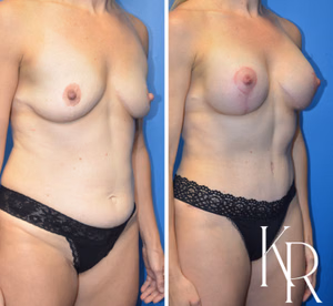 Mommy makeover before and after photo, side view