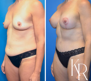 Mommy makeover before and after photo, front view