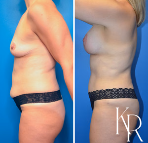 Mommy makeover before and after photo, side view