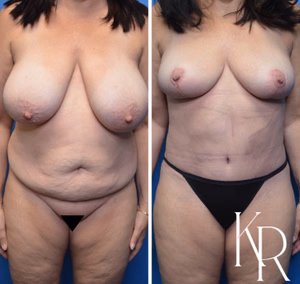 Mommy makeover before and after photo, front view