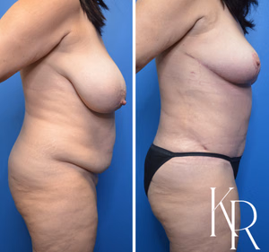 Mommy makeover before and after photo, side view