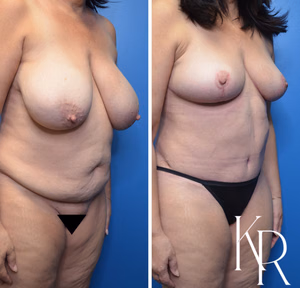 Mommy makeover before and after photo, front view
