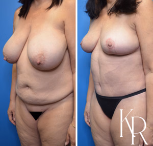 Mommy makeover before and after photo, front view