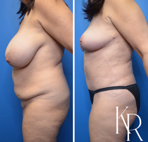 Mommy makeover before and after photo, side view