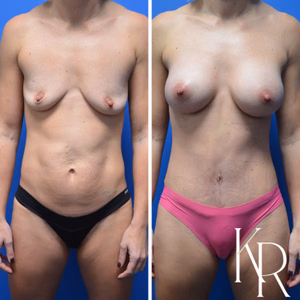 Mommy makeover before and after photo, front view