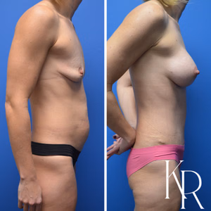 Mommy makeover before and after photo, side view
