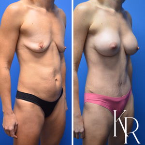 Mommy makeover before and after photo, front view