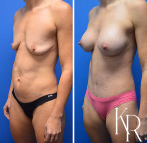 Mommy makeover before and after photo, front view
