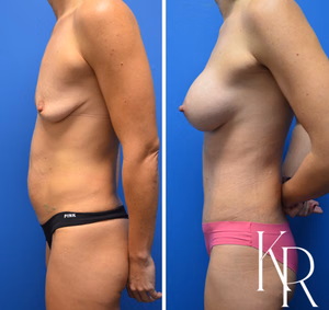 Mommy makeover before and after photo, side view