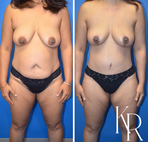 Mommy makeover before and after photo, front view