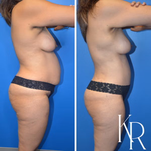 Mommy makeover before and after photo, side view