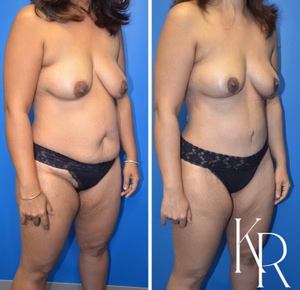 Mommy makeover before and after photo, front view