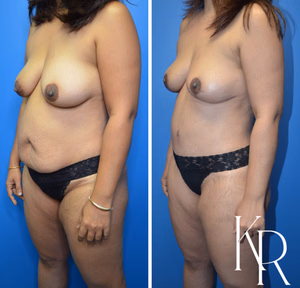 Mommy makeover before and after photo, front view