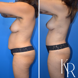Mommy makeover before and after photo, side view