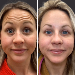 Botox before and after photo, close-up view
