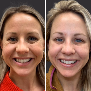 Botox before and after photo, close-up view