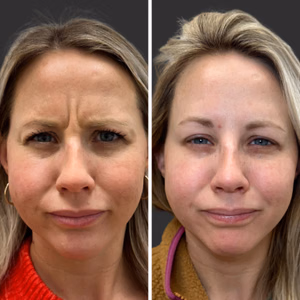 Botox before and after photo, close-up view