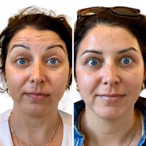 Botox before and after photo, close-up view