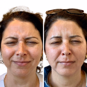 Botox before and after photo, close-up view