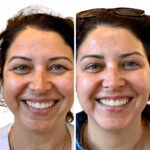 Botox before and after photo, close-up view