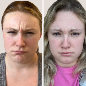 Botox before and after photo, close-up view