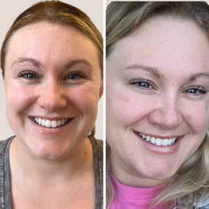 Botox before and after photo, close-up view