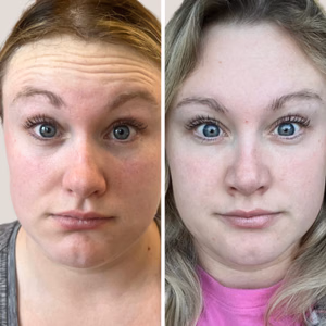 Botox before and after photo, close-up view